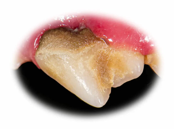 Red, swollen gums with tartar