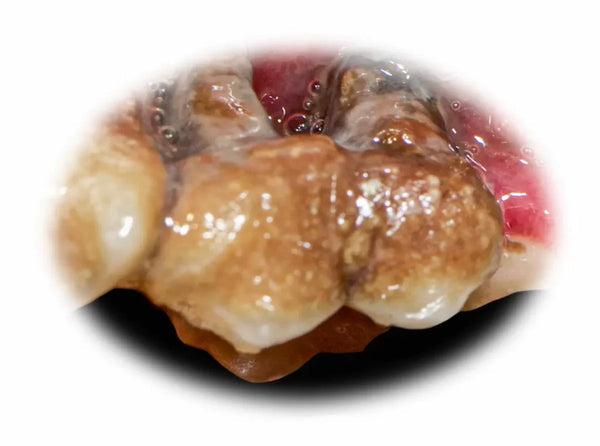 Advanced periodontal disease