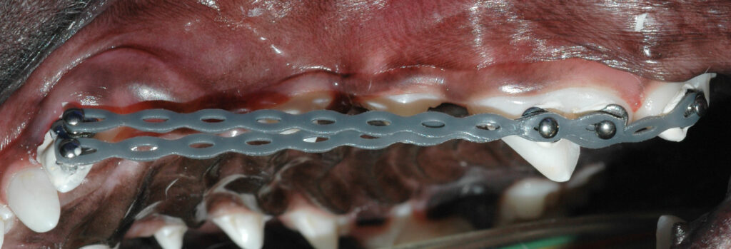 Elastic and orthodontic buttons used to pull the canine tooth backward